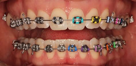 types of metal braces brackets|standard metal braces.